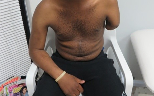 Above Elbow Amputation