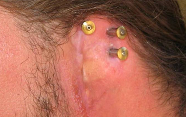 Facial Prosthesis
