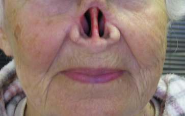 Facial Prosthesis