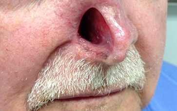 Facial Prosthesis