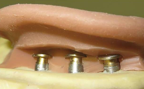 Osseointegrated Prosthetic Ear Implant