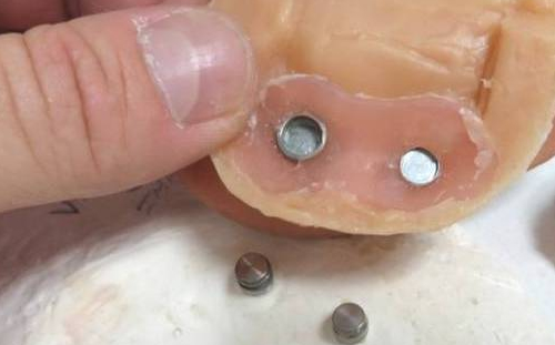 Osseointegrated Prosthetic Ear Implant