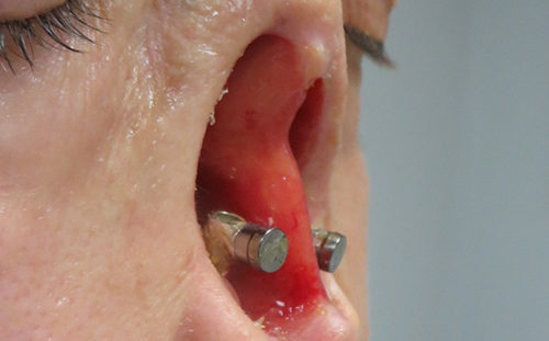 Osseointegrated Prosthetic Nose Implant