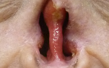 Osseointegrated Implant Placement