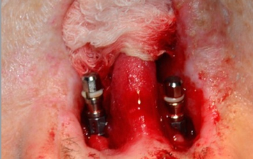 Osseointegrated Implant Placement