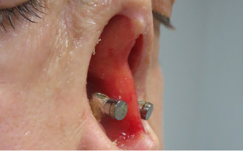 Osseointegrated Implant Placement