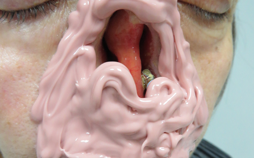 Silicone Impression