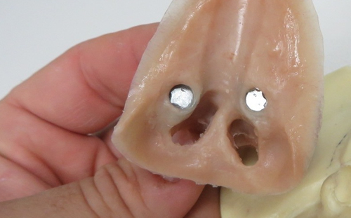 Prosthesis Manufactured