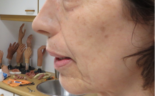 Prosthesis Fitted