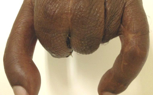Finger Amputation