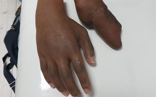 No Thumb