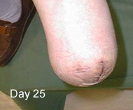Compression Liner
