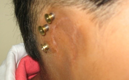 Osseointegrated Implant
