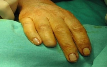 Pre-Surgery