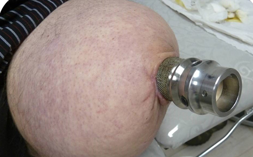 Osseointegrated Implant