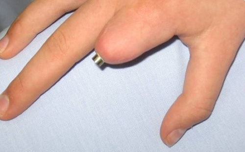Osseointegrated Implant