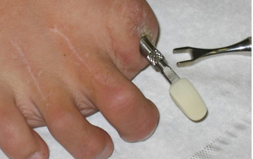 Osseointegrated implant