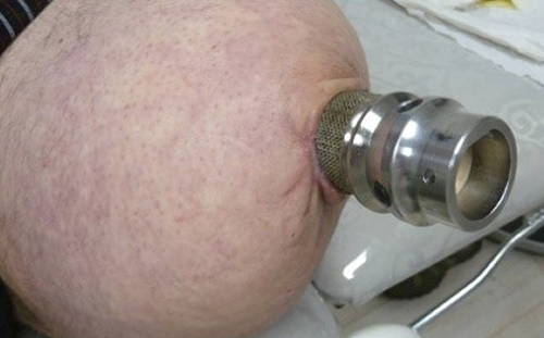 Osseointegrated implant