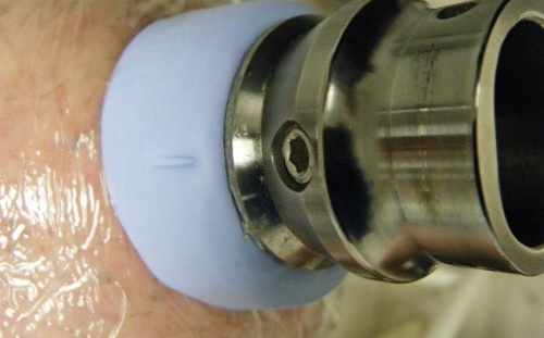 Osseointegrated implant