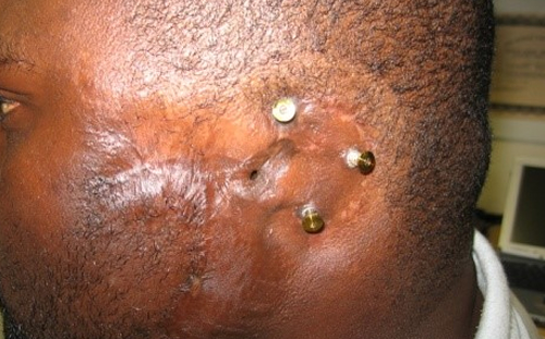 Osseointegrated implant
